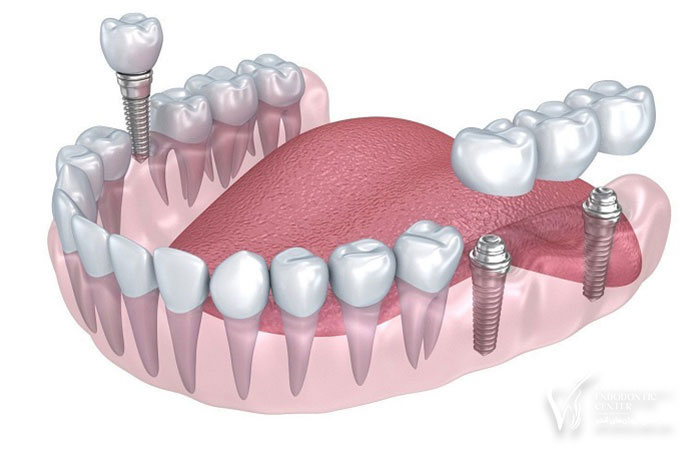 علائم نارسائی ایمپلنت دندان